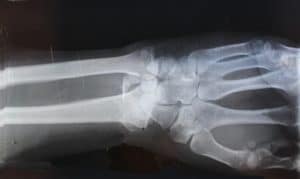 xray of human wrist